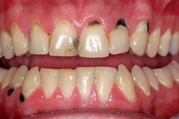 некроз твердых тканей зуба