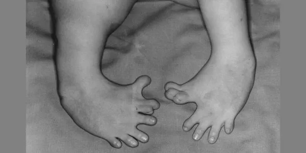 Деформация ног у новорождённого, мать которого принимала талидомид. Побочные эффекты препарата называют примером действий биг фармы